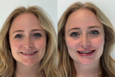 Dermal Fillers Before & After Gallery - Patient 385023 - Image 1