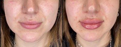 Dermal Fillers Before & After Gallery - Patient 103612 - Image 1