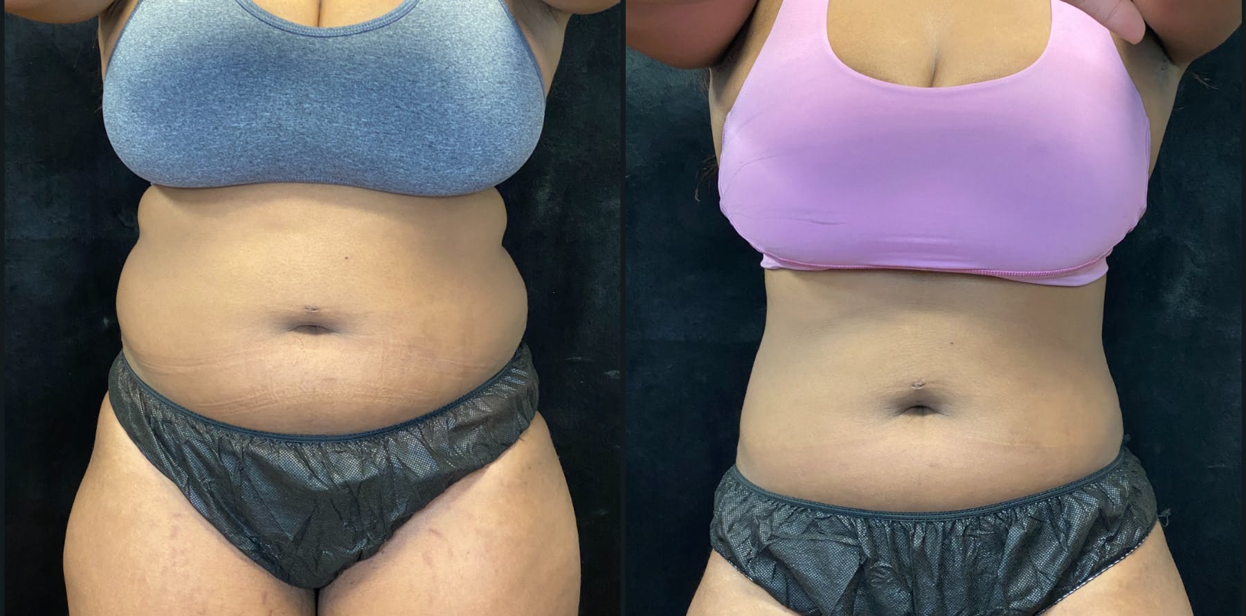 Weight Management Before & After Gallery - Patient 360773 - Image 1