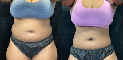 Weight Management Before & After Gallery - Patient 360773 - Image 1