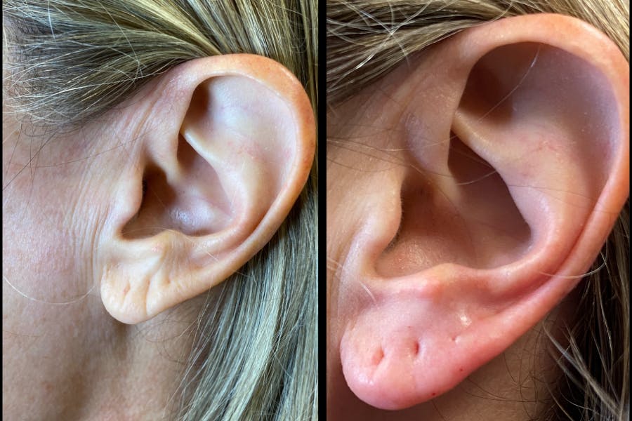 Dermal Fillers Before & After Gallery - Patient 141218 - Image 1