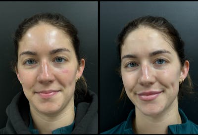 Dermal Fillers Before & After Gallery - Patient 106595 - Image 1