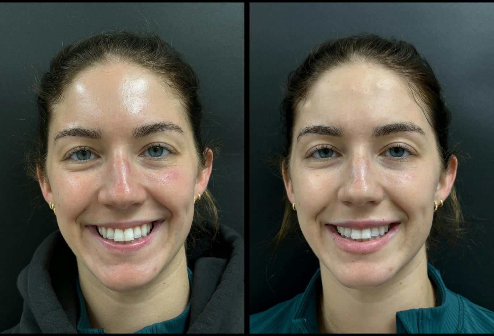 Dermal Fillers Before & After Gallery - Patient 106595 - Image 2