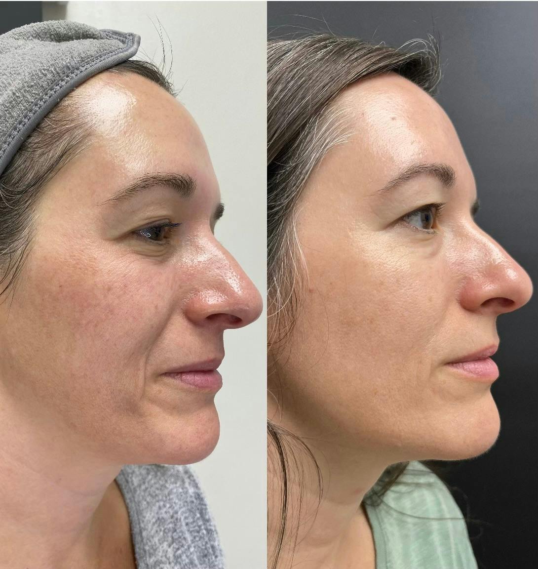 Medical Grade Facial  Before & After Gallery - Patient 344509 - Image 1