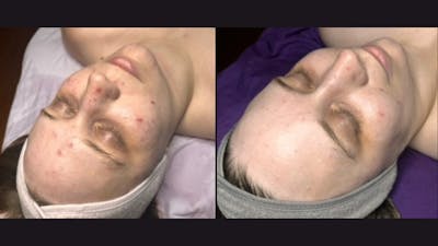 Medical Grade Facial  Before & After Gallery - Patient 329556 - Image 1