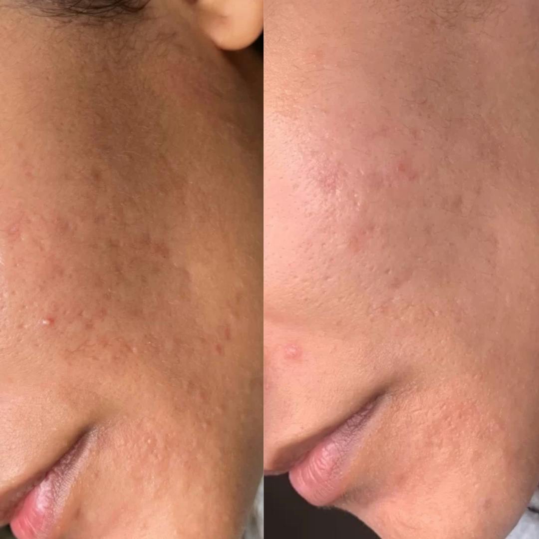 Microneedling Before & After Gallery - Patient 364077 - Image 1