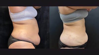 Morpheus8 for Body Before & After Gallery - Patient 426443 - Image 1