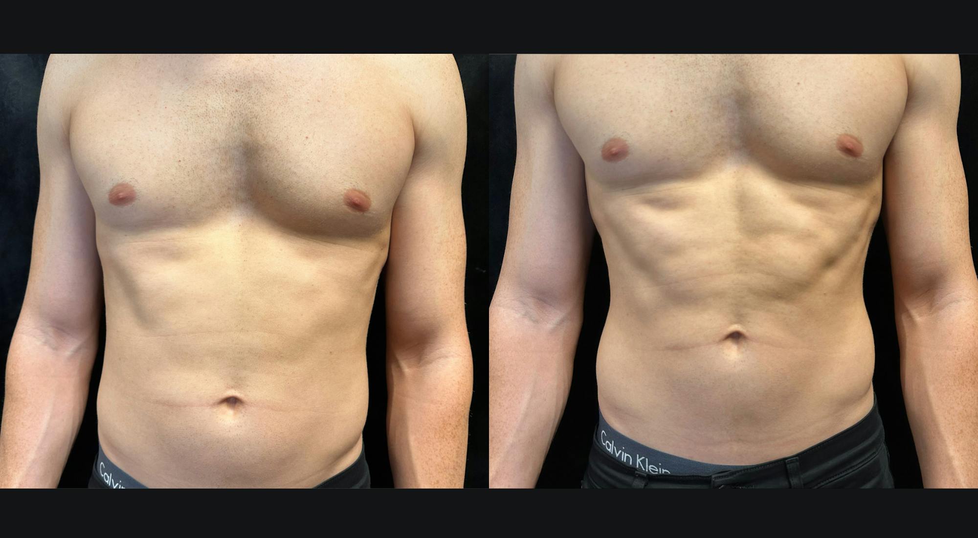 EvolveX Before & After Gallery - Patient 195889 - Image 1
