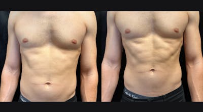 EvolveX Before & After Gallery - Patient 195889 - Image 1