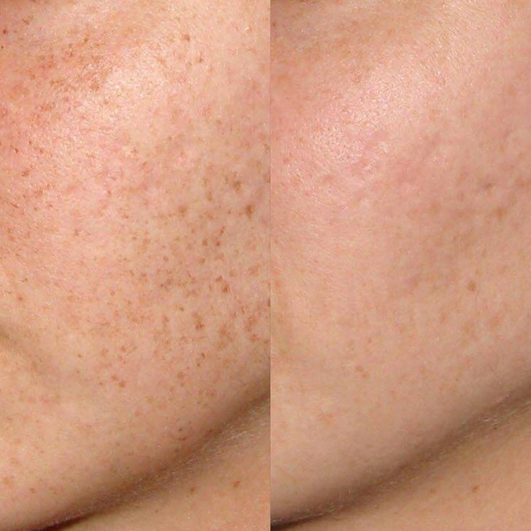 IPL for Face Before & After Gallery - Patient 173718 - Image 1