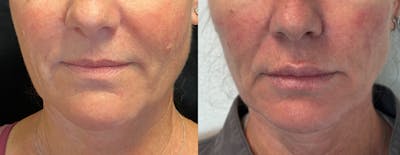 Dermal Fillers Before & After Gallery - Patient 293840 - Image 1