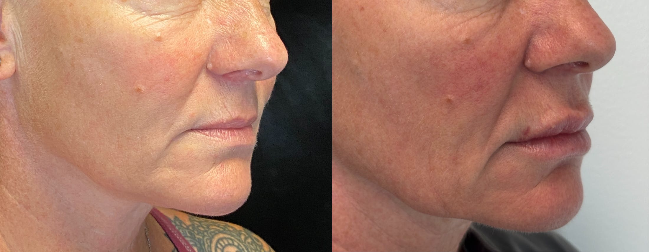 Dermal Fillers Before & After Gallery - Patient 293840 - Image 2