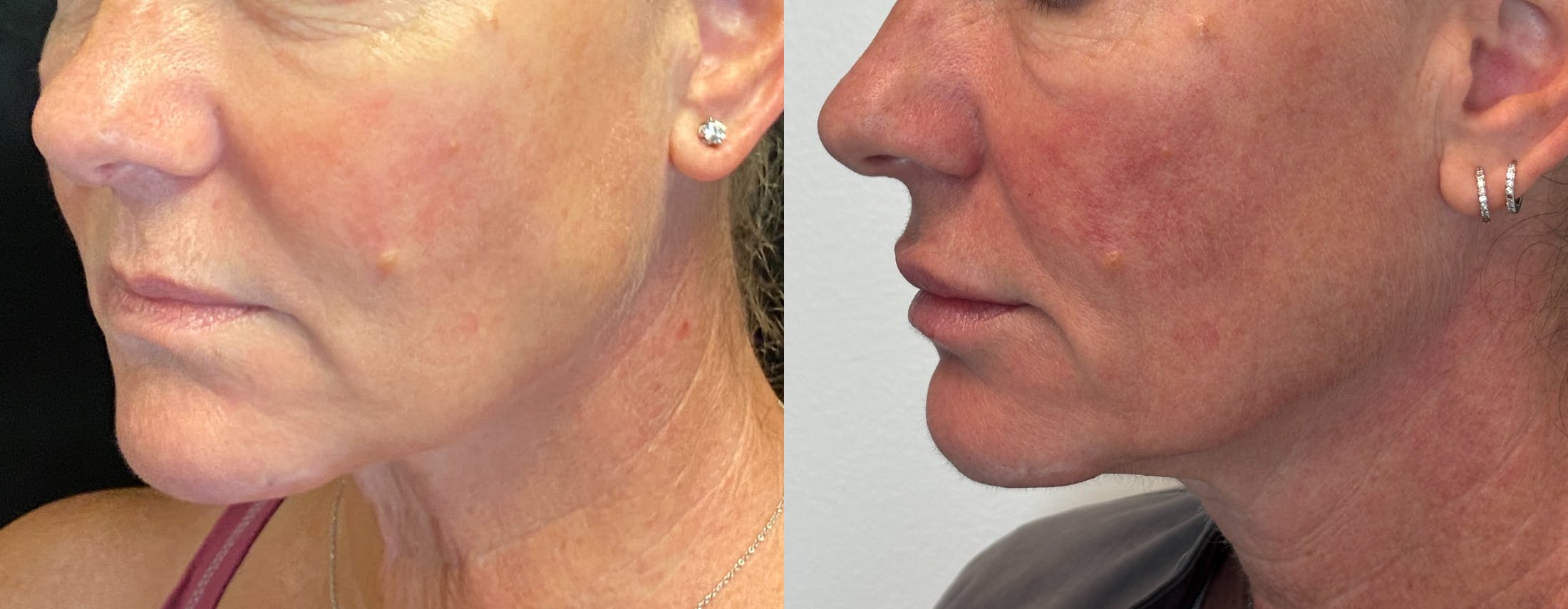 Dermal Fillers Before & After Gallery - Patient 293840 - Image 3