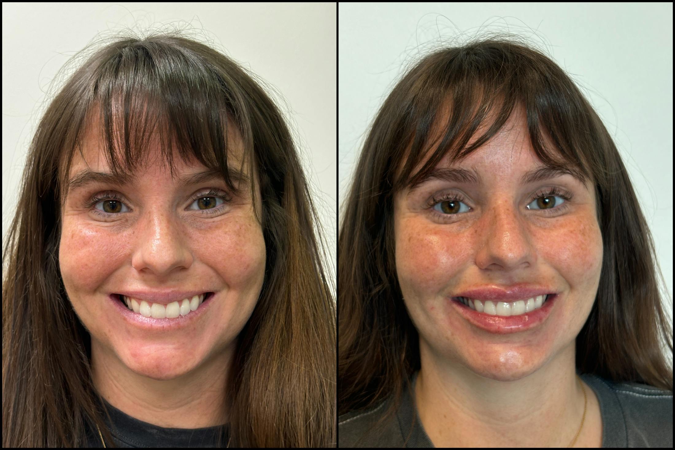 Dermal Fillers Before & After Gallery - Patient 291173 - Image 1
