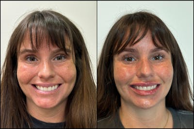 Dermal Fillers Before & After Gallery - Patient 291173 - Image 1
