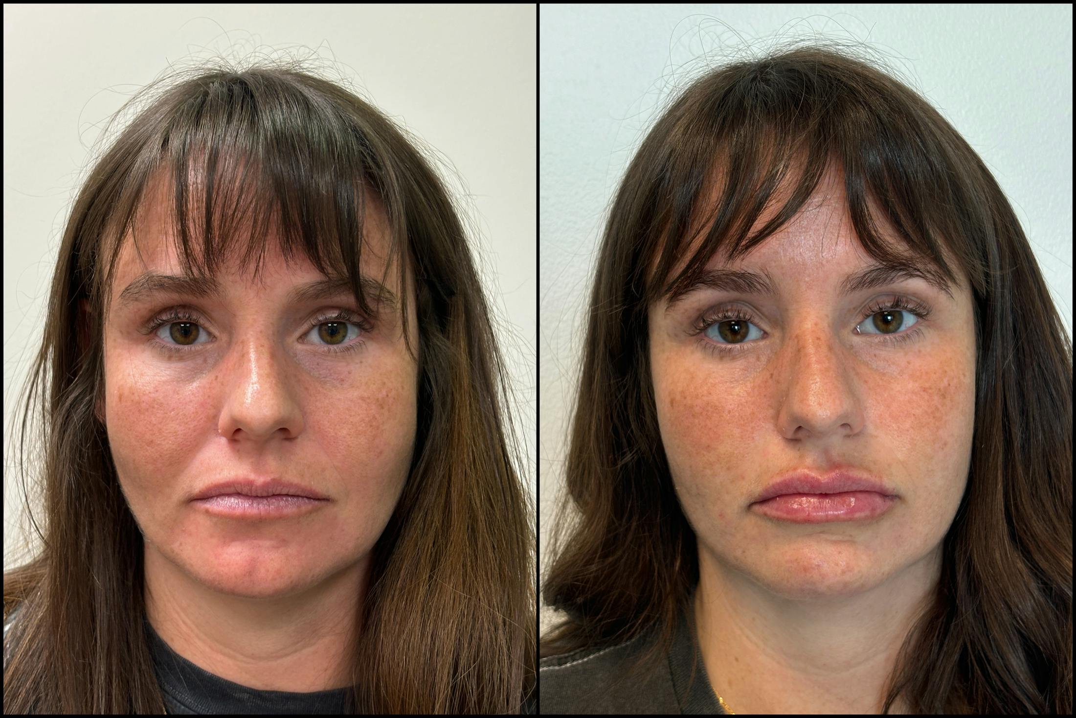 Dermal Fillers Before & After Gallery - Patient 291173 - Image 2