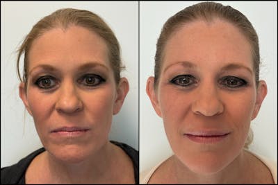 Dermal Fillers Before & After Gallery - Patient 372508 - Image 1