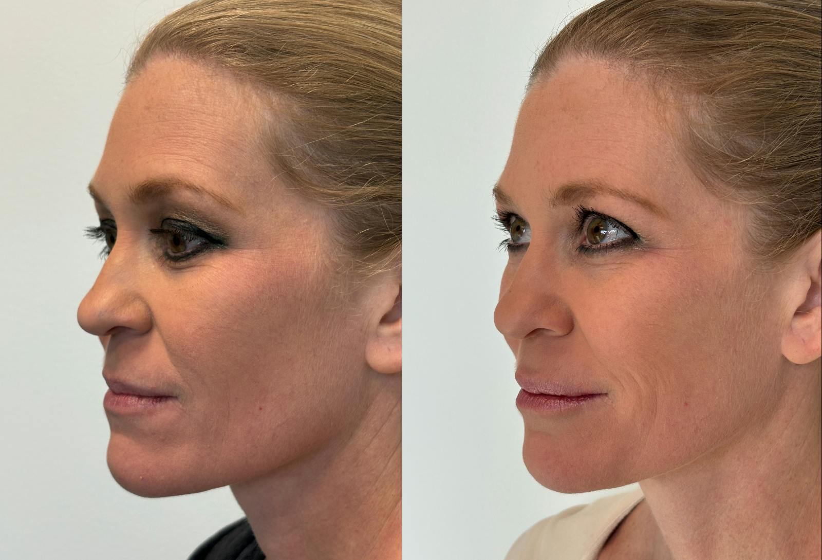 Dermal Fillers Before & After Gallery - Patient 372508 - Image 3