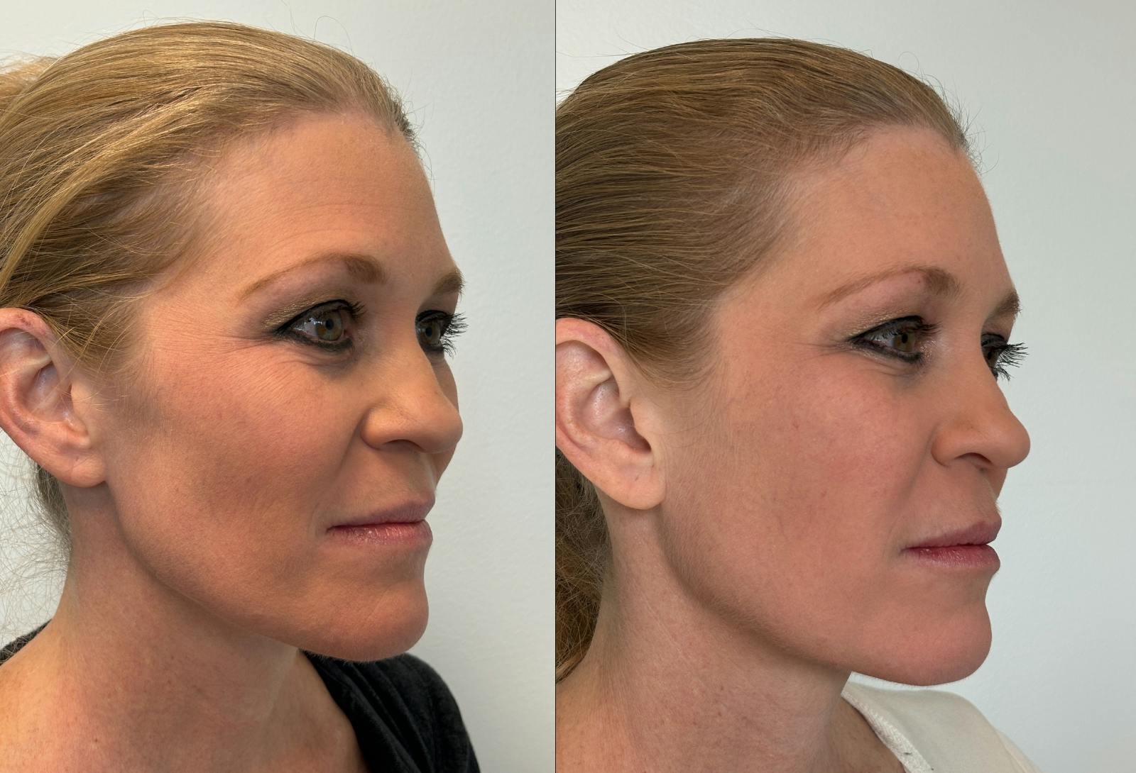 Dermal Fillers Before & After Gallery - Patient 372508 - Image 2
