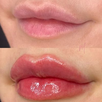 Dermal Fillers Before & After Gallery - Patient 928384 - Image 1