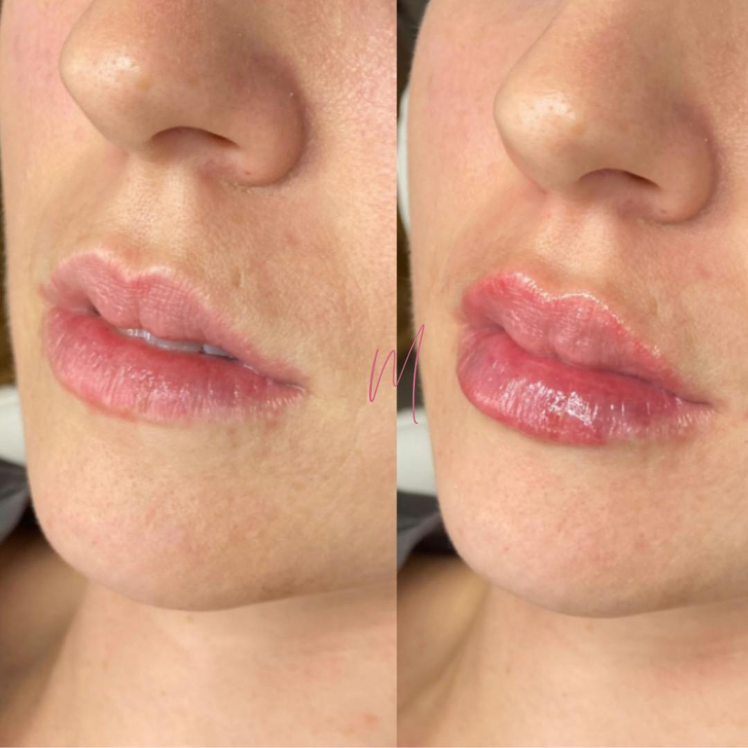 Dermal Fillers Before & After Gallery - Patient 409886 - Image 1