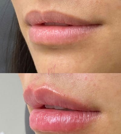 Dermal Fillers Before & After Gallery - Patient 465467 - Image 1