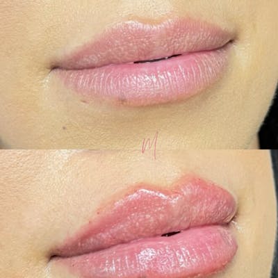 Dermal Fillers Before & After Gallery - Patient 267214 - Image 1