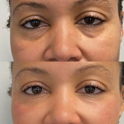 PRP Eye Rejuvenation Before & After Gallery - Patient 547266 - Image 1