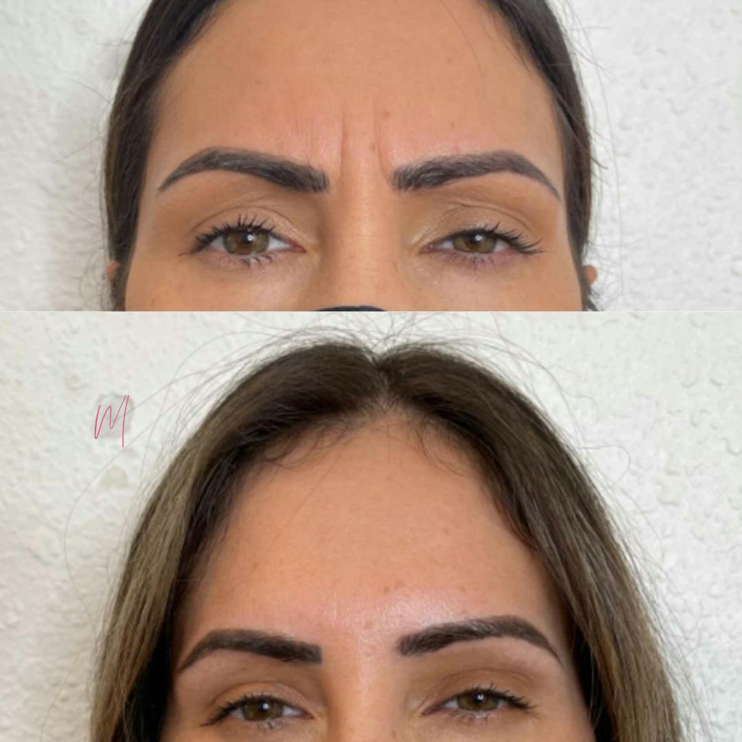 BOTOX/Dysport Before & After Gallery - Patient 747056 - Image 1