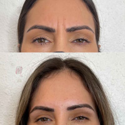BOTOX/Dysport Before & After Gallery - Patient 747056 - Image 1