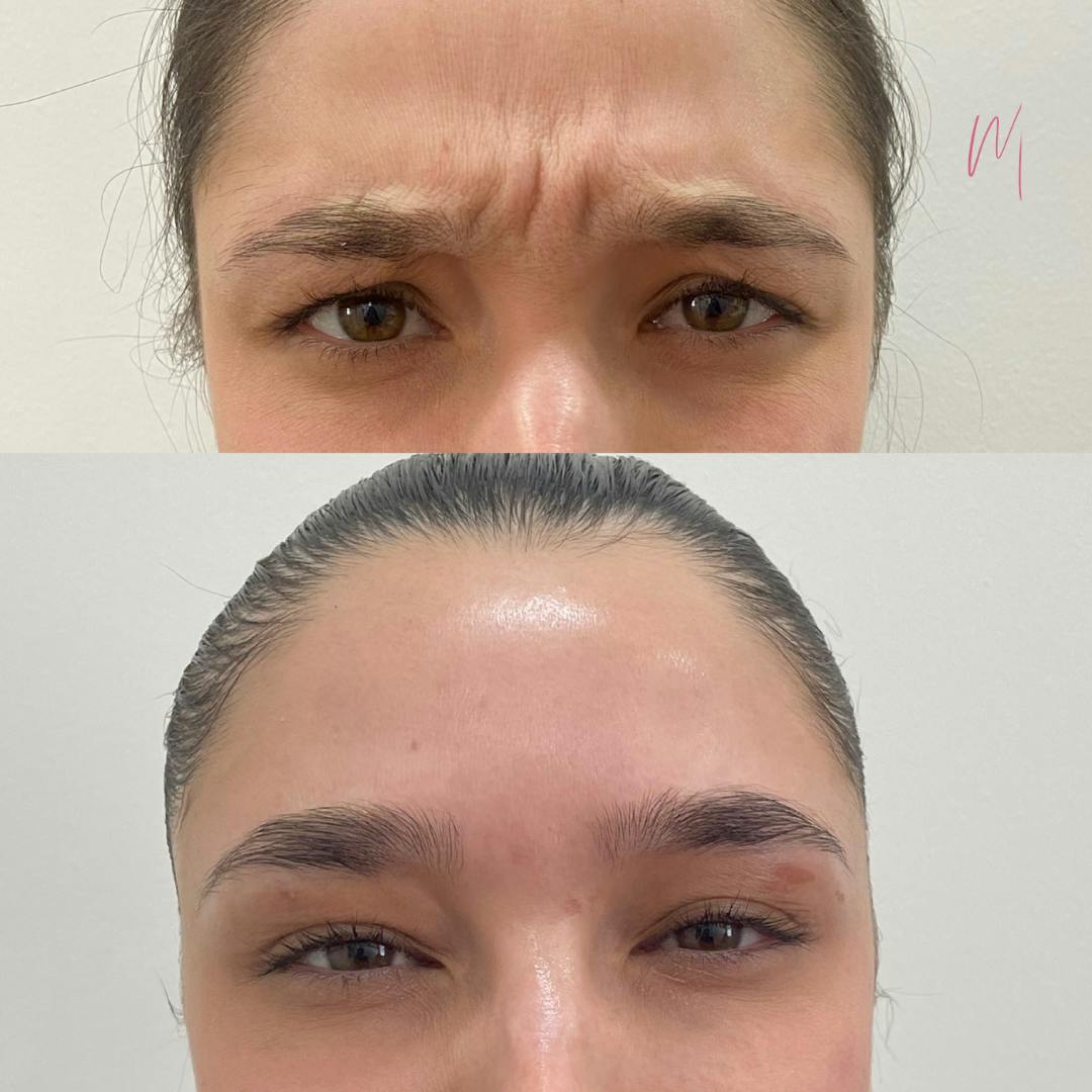 BOTOX/Dysport Before & After Gallery - Patient 314886 - Image 1