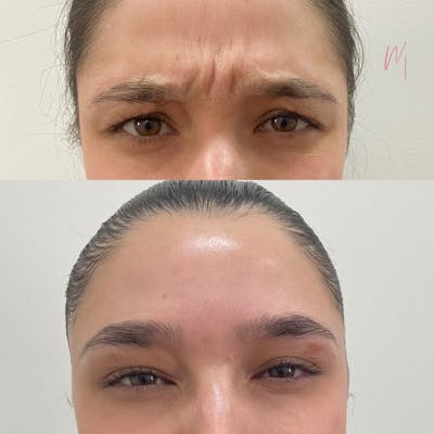 BOTOX/Dysport Before & After Gallery - Patient 314886 - Image 1