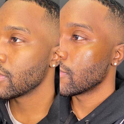 Dermal Fillers Before & After Gallery - Patient 160673 - Image 1