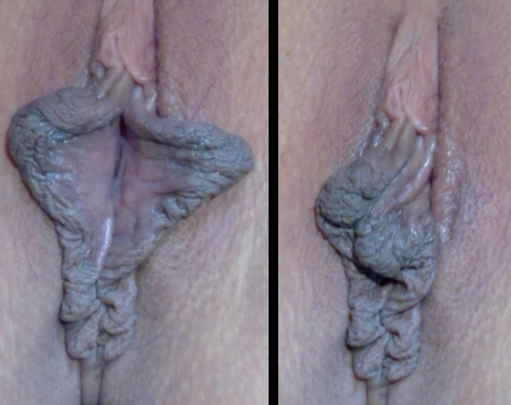 Labiaplasty Before & After Gallery - Patient 133069 - Image 1
