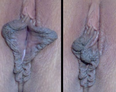 Labiaplasty Before & After Gallery - Patient 133069 - Image 1