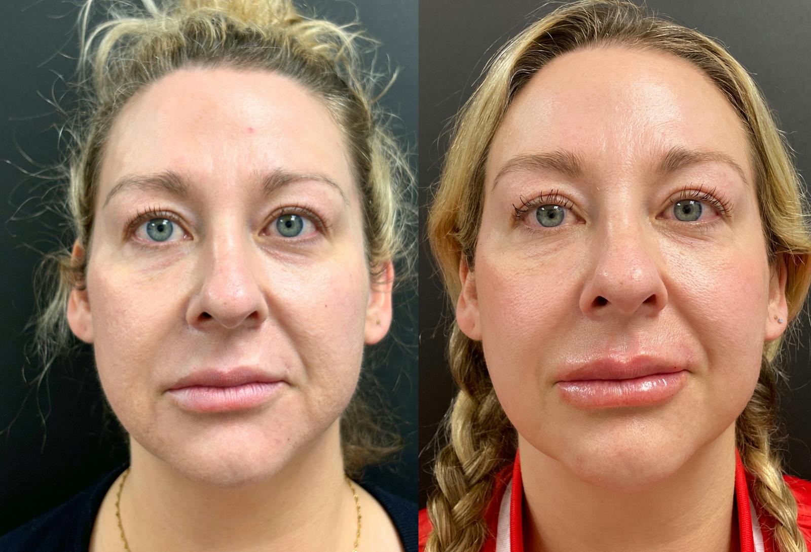 Dermal Fillers Before & After Gallery - Patient 971862 - Image 1