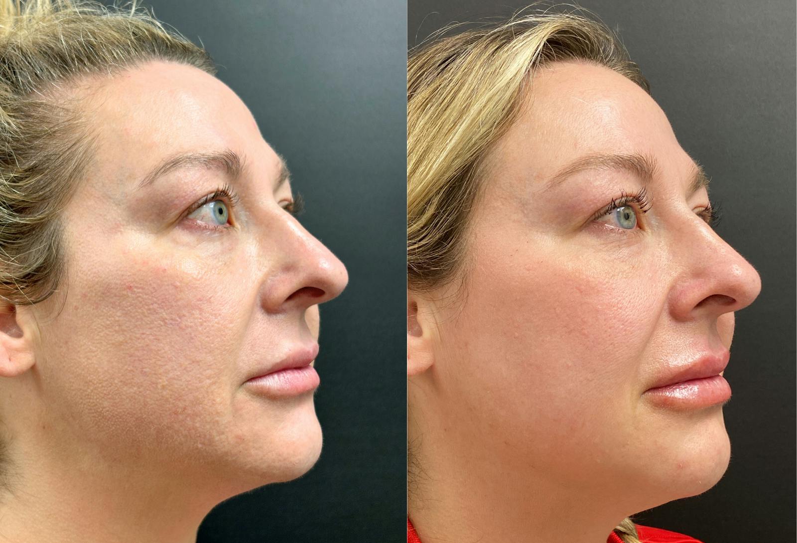 Dermal Fillers Before & After Gallery - Patient 971862 - Image 2