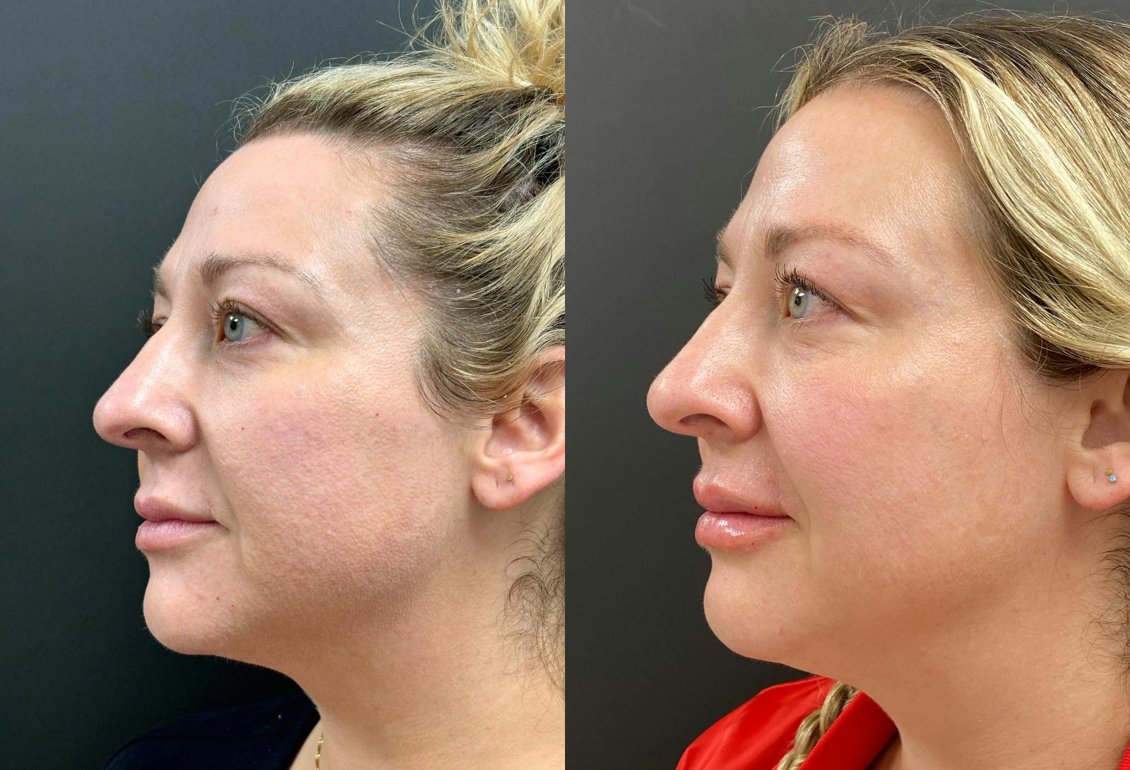 Dermal Fillers Before & After Gallery - Patient 971862 - Image 3