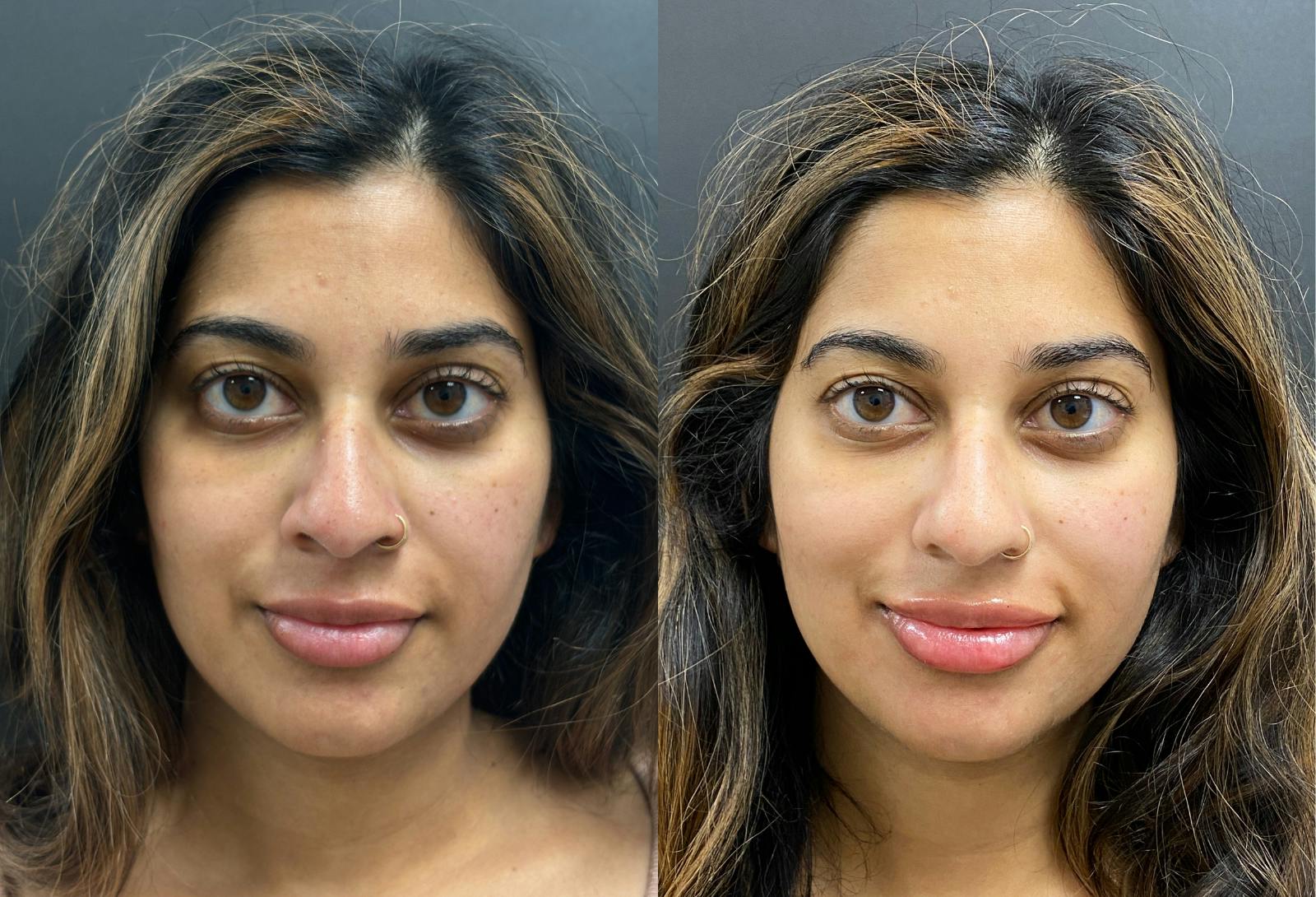 Dermal Fillers Before & After Gallery - Patient 752166 - Image 1