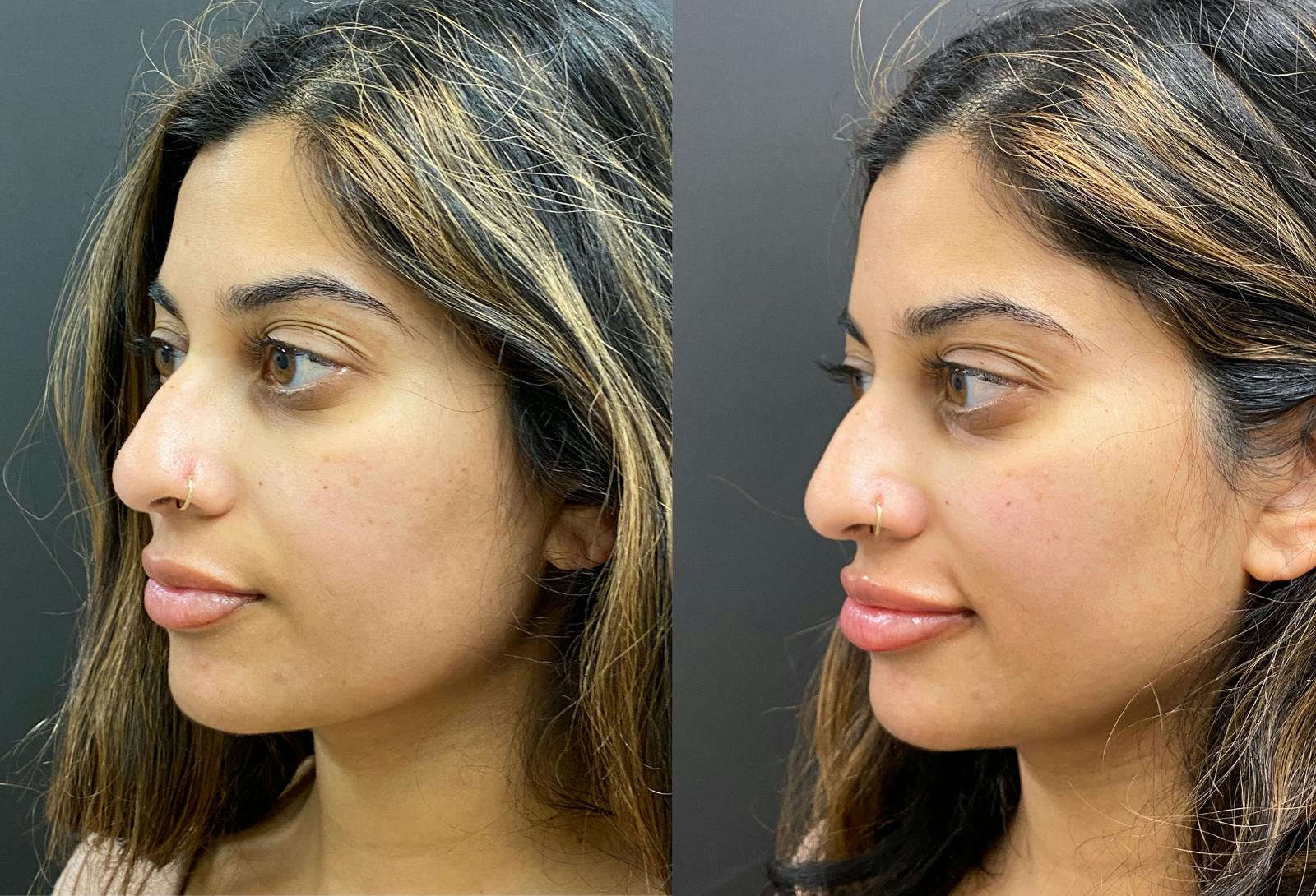 Dermal Fillers Before & After Gallery - Patient 752166 - Image 3