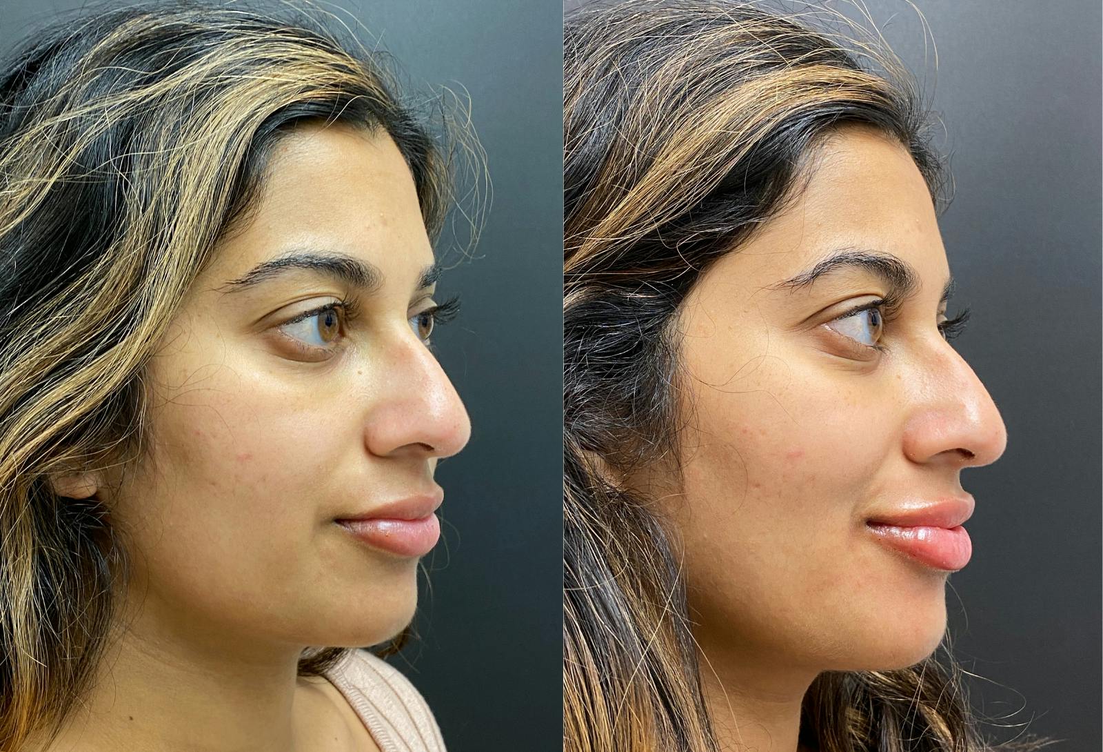 Dermal Fillers Before & After Gallery - Patient 752166 - Image 2