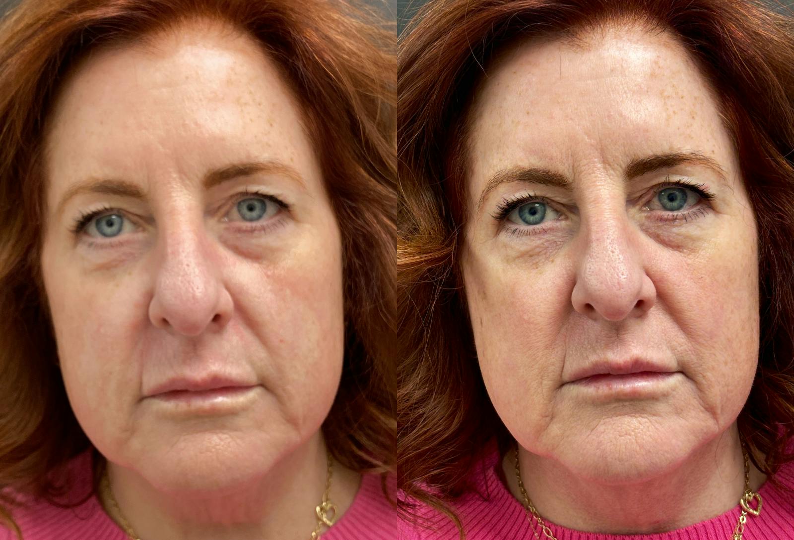 Dermal Fillers Before & After Gallery - Patient 208396 - Image 1