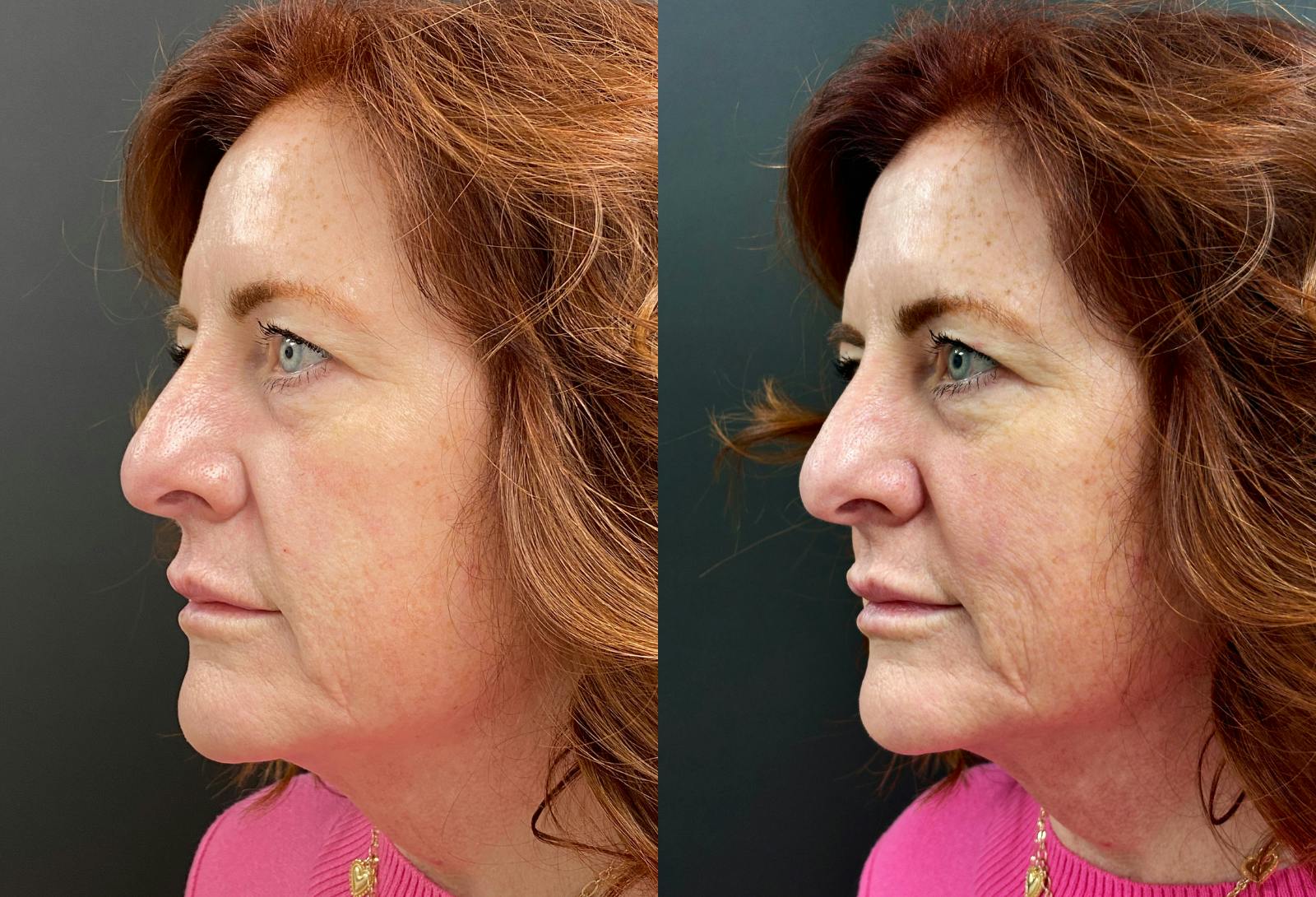 Dermal Fillers Before & After Gallery - Patient 208396 - Image 2