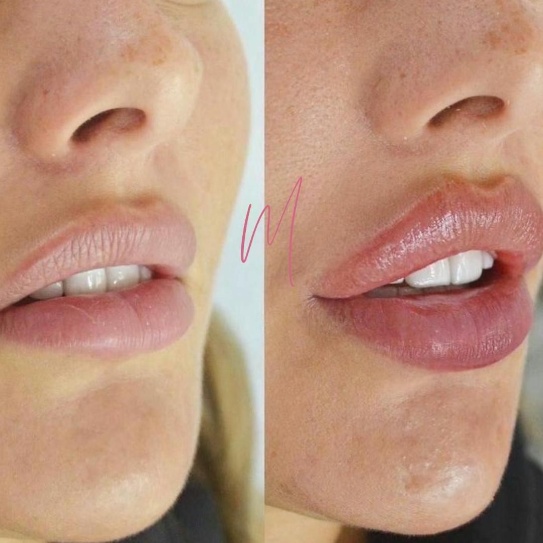 Dermal Fillers Before & After Gallery - Patient 120414 - Image 1