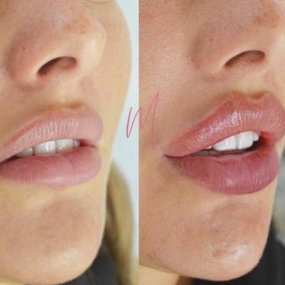 Dermal Fillers Before & After Gallery - Patient 120414 - Image 1
