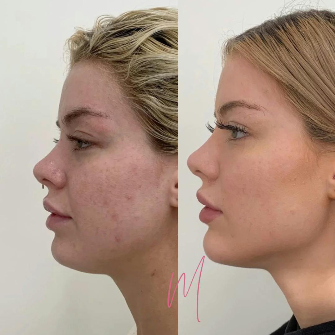 Dermal Fillers Before & After Gallery - Patient 568972 - Image 1