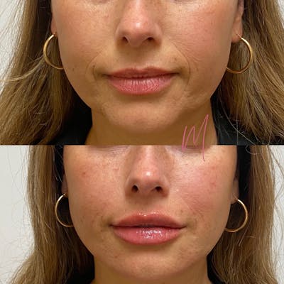 Dermal Fillers Before & After Gallery - Patient 254478 - Image 1