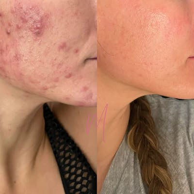 Chemical Peels Before & After Gallery - Patient 434900 - Image 1