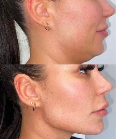 Evoke Before & After Gallery - Patient 122423 - Image 1