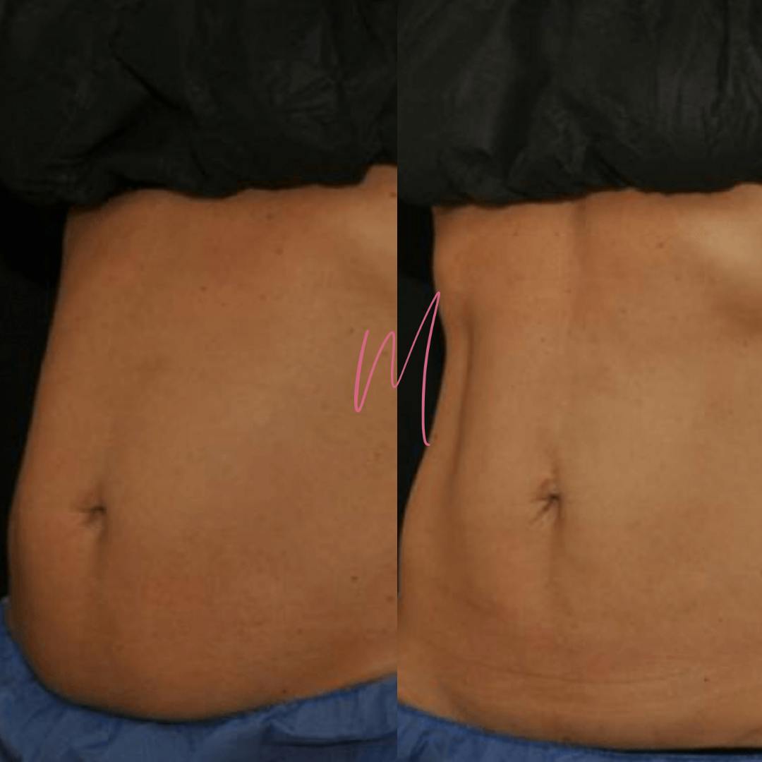 EvolveX Before & After Gallery - Patient 363650 - Image 1